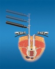 Image guidance for ALIF, PLIF, TLIF and DLIF