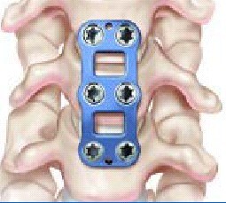 Metal plate for anterior cervical discectomy and fusion (acdf)