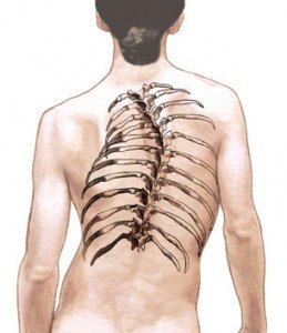 scoliosis